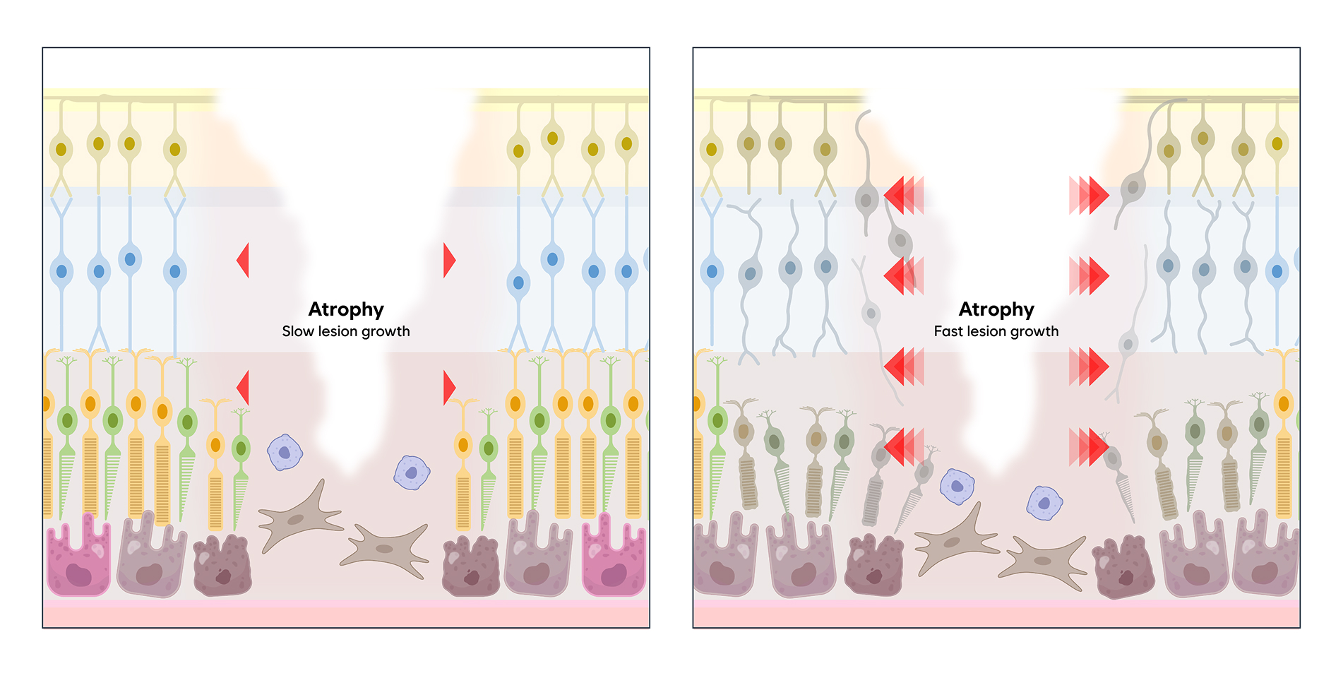 Progressive Atrophy Rpe EG103 | Elisigen