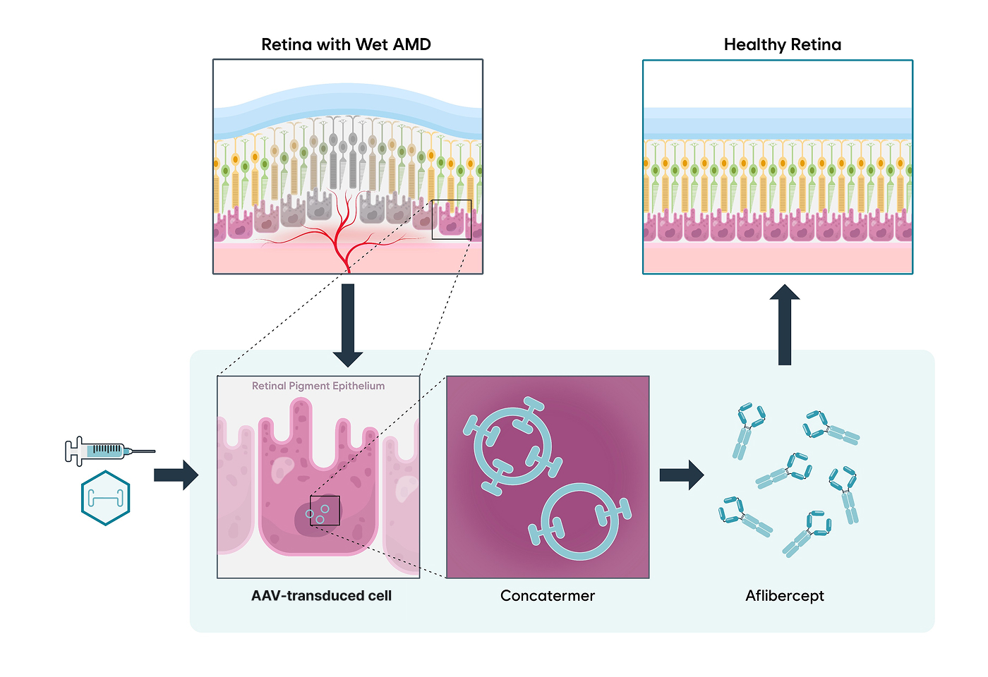 NG101 mechanism: subretinal delivery and retinal expression
